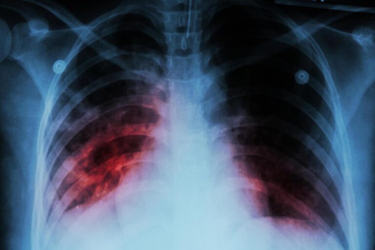 New tuberculosis case detected in Northern California. Here’s what to know