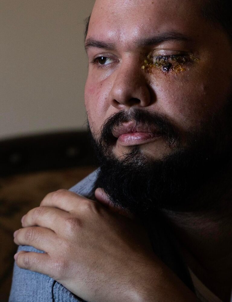 Second man shares horrific story of being blinded by officers at anti-ICE rally in Santa Ana