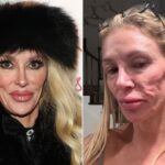 Brandi Glanville Claims Ruptured Breast Implants Led to Facial Parasite Diagnosis