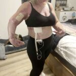 After a Fireplace Explosion, One Australian Mother’s Journey From Survival to Strength